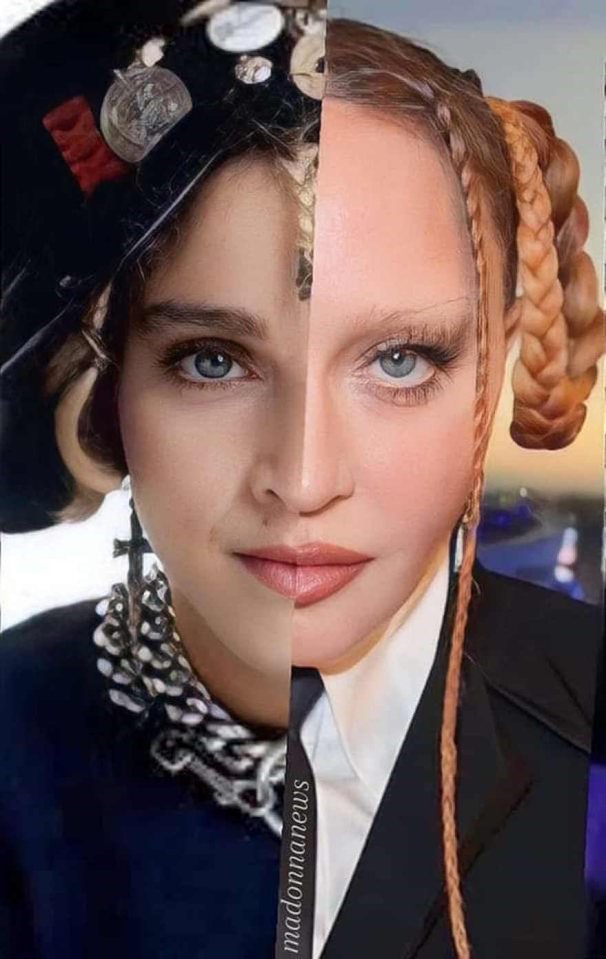 Μαντόνα: «Έχει ψύχωση με τα μάγουλά της» - Ομάδα ειδικών φροντίζει το πρησμένο πρόσωπό της