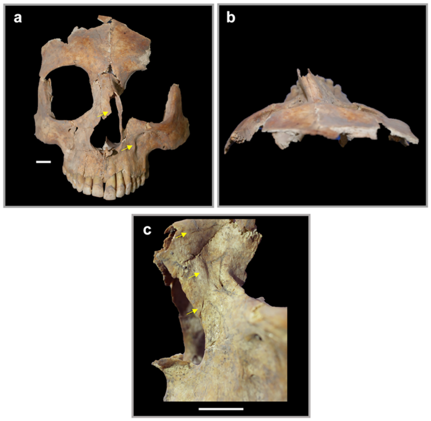 Αρχαιολόγοι ανακάλυψαν στο Ισραήλ την πρώτη επέμβαση στον εγκέφαλο πριν από 3.500 χρόνια