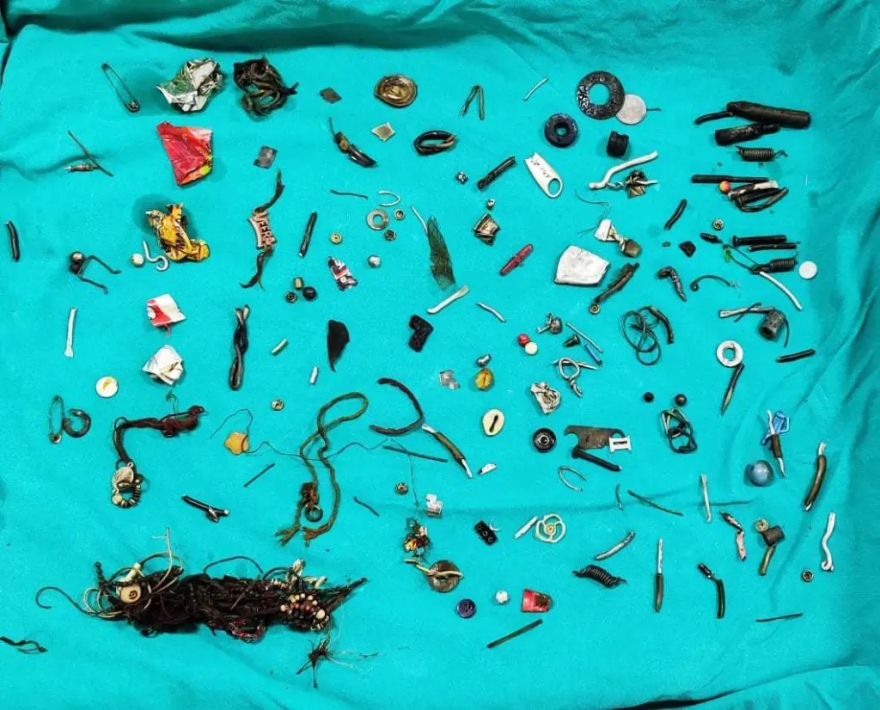 Ινδία: Άνδρας πήγε με στομαχόπονο στο νοσοκομείο και οι γιατροί έβγαλαν από το έντερό του 60 αντικείμενα