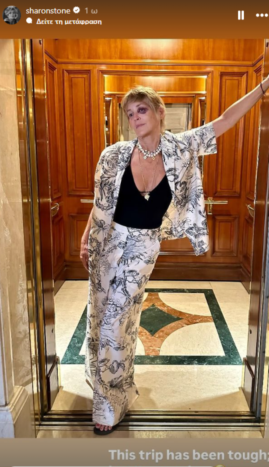 Σάρον Στόουν: Με μαυρισμένο μάτι σε φωτογραφία από τις διακοπές της στην Τουρκία