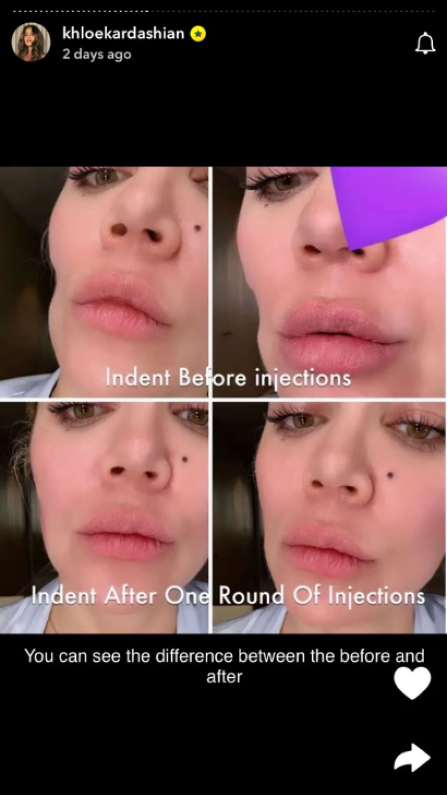 Κλόε Καρντάσιαν: Έδειξε πώς άλλαξε το πρόσωπό της μετά την αφαίρεση όγκου από το μάγουλό της