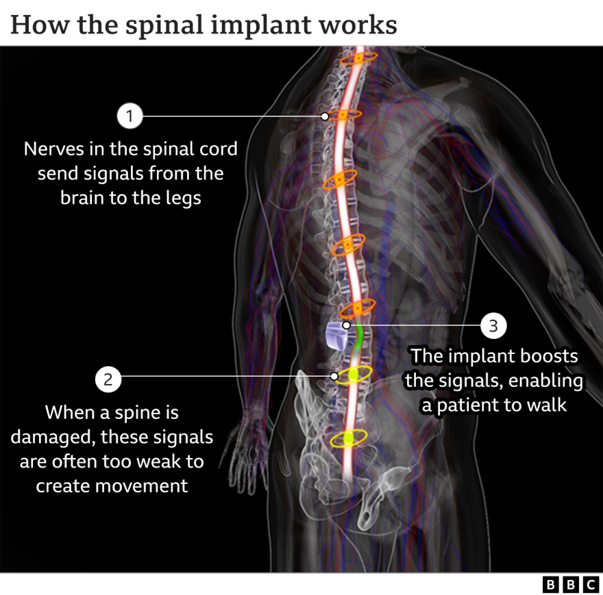 _123131391_spinal_implant_640-2x-nc
