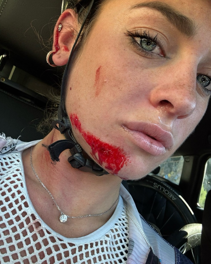 Ιταλίδα πρωταθλήτρια της ποδηλασίας και μοντέλο δείχνει τα τραύματά της μετά από πτώση - «Θα επιστρέψω σύντομα και πιο δυνατή»