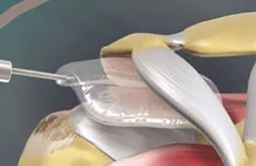 Οστεοαρθρίτιδα Ώμου - Ρήξη Στροφικού Πετάλου: Θεραπείες πριν την Αρθροπλαστική