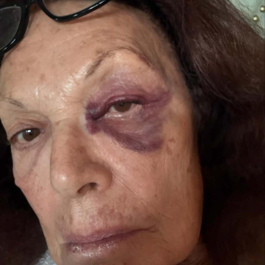 Νταϊάν φον Φίρστενμπεργκ: Με μαυρισμένο μάτι στο Instagram - Ευτυχώς δεν είναι κάτι σοβαρό, έγραψε