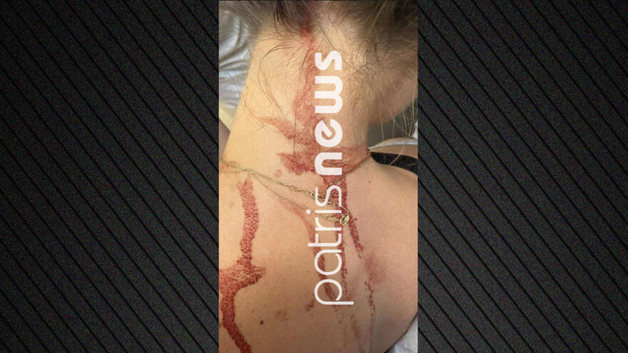 Στη φυλακή η 48χρονη που επιτέθηκε κάρφωσε με ψαλίδι γυναίκα στην Αμαλιάδα