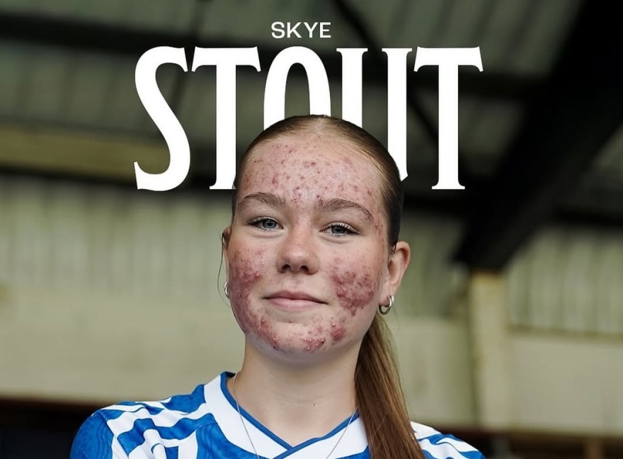 1 στους 5 εφήβους με σοβαρή ακμή αναπτύσσει συμπτώματα κατάθλιψης