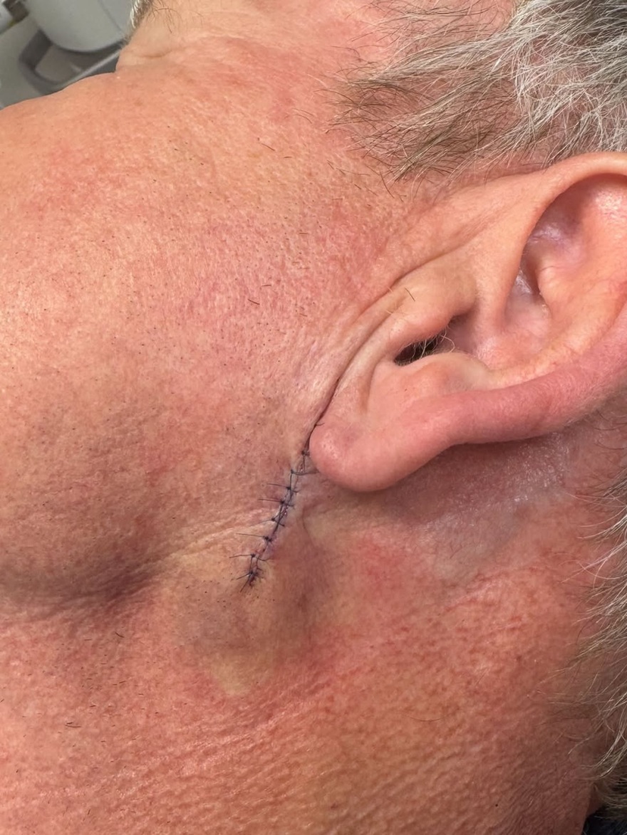 Γκόρντον Ράμσεϊ: Φωτογραφίες με ράμματα στο πρόσωπο μετά την αφαίρεση καρκινώματος στο δέρμα