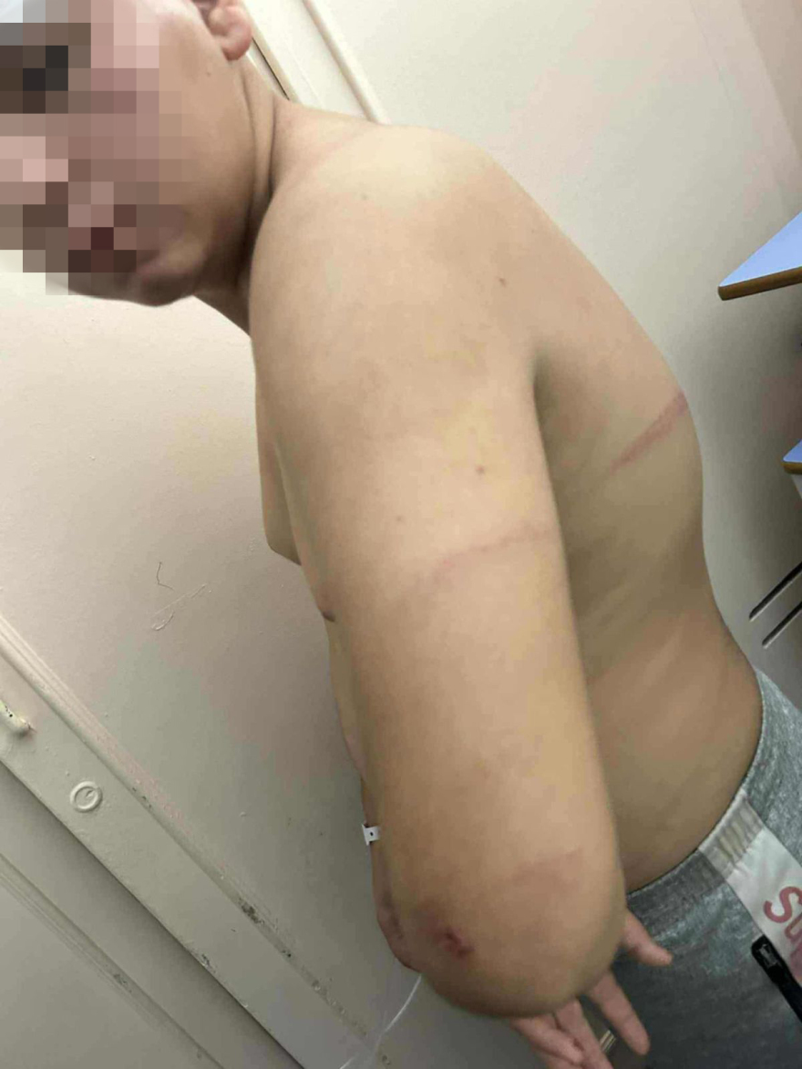 Θεσσαλονίκη: «Τον χτυπούσαν με μπετόβεργες, έχει τρύπες 15 πόντους στο κεφάλι» - Ξεσπά ο πατέρας του 13χρονου που ξυλοκοπήθηκε