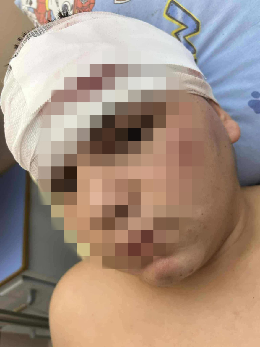 Θεσσαλονίκη: «Τον χτυπούσαν με μπετόβεργες, έχει τρύπες 15 πόντους στο κεφάλι» - Ξεσπά ο πατέρας του 13χρονου που ξυλοκοπήθηκε