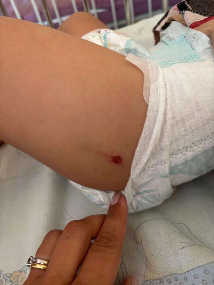 Εκδορές και δαγκώματα έχει το 5χρονο παιδί μετά την επίθεση από λύκο στη Χαλκιδική - Βίντεο δείχνει το ζώο να κυκλοφορεί ανενόχλητο στην παραλία