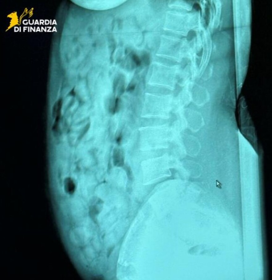 Συνελήφθη 46χρονη στο Μπέργκαμο με 120 αμπούλες ηρωίνης στο στομάχι της - Δείτε φωτογραφία