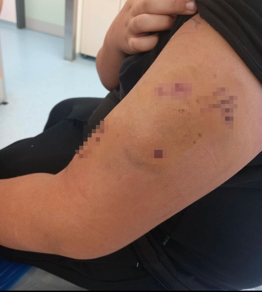 Επίθεση σκύλου σε 12χρονο έξω από σχολείο στο Πέραμα - «Ζητώ την τιμωρία του ιδιοκτήτη» λέει η μητέρα του