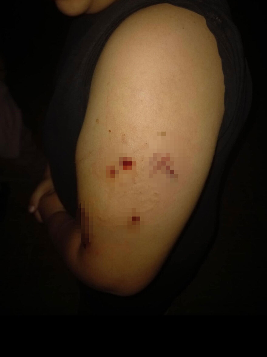 Επίθεση σκύλου σε 12χρονο έξω από σχολείο στο Πέραμα - «Ζητώ την τιμωρία του ιδιοκτήτη» λέει η μητέρα του