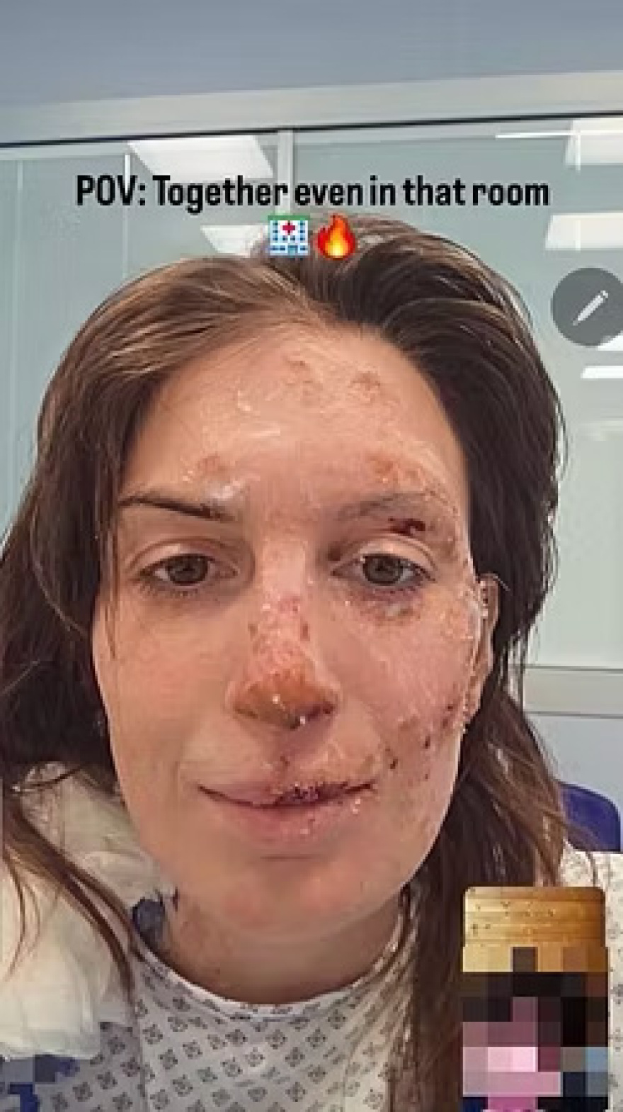 «Η ψυχή χρειάζεται περισσότερο χρόνο για να επουλωθεί»: Εξιτήριο για 29χρονη μετά τη φωτιά στο Κραν Μοντανά, ο μακρύς δρόμος της αποκατάστασης