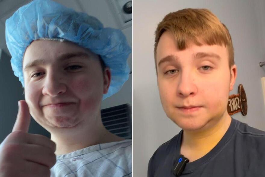 Ο άνθρωπος που υποβλήθηκε σε διπλή επέμβαση γνάθου: Η μεγάλη αλλαγή στην εμφάνισή του