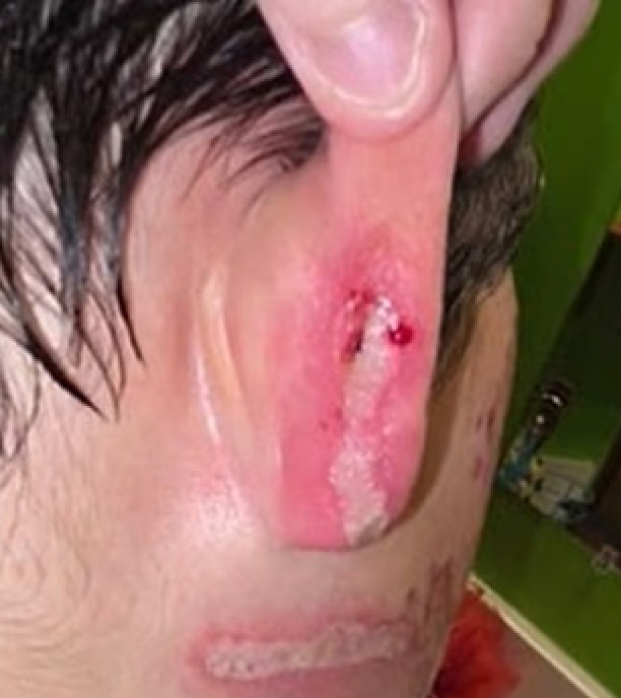 Σοβαρά εγκαύματα από φούρνο μικροκυμάτων υπέστη 9χρονος στο Ιλινόι για ένα trend στο Tik Tok: Δείτε βίντεο