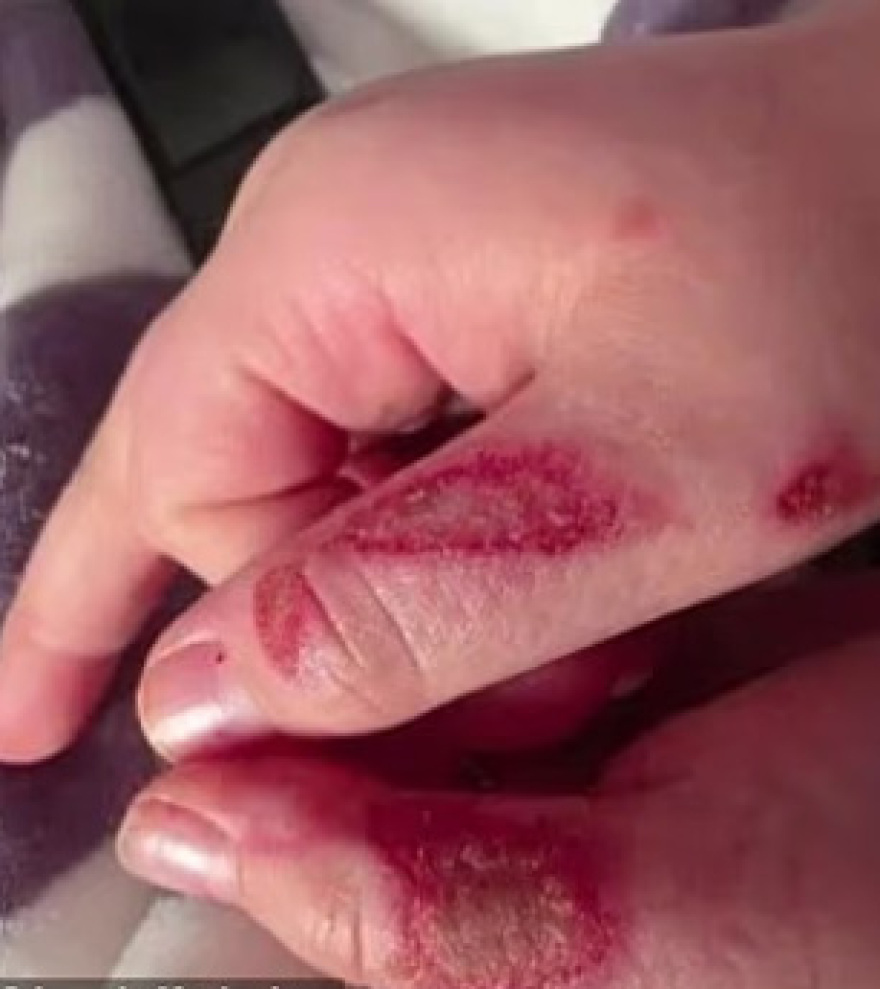 Σοβαρά εγκαύματα από φούρνο μικροκυμάτων υπέστη 9χρονος στο Ιλινόι για ένα trend στο Tik Tok: Δείτε βίντεο