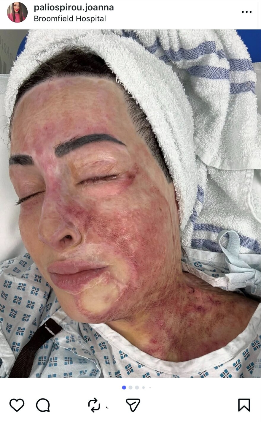 Η Ιωάννα Παλιοσπύρου ανέβασε εικόνες και βίντεο από την αποκατάσταση μετά την επίθεση με βιτριόλι