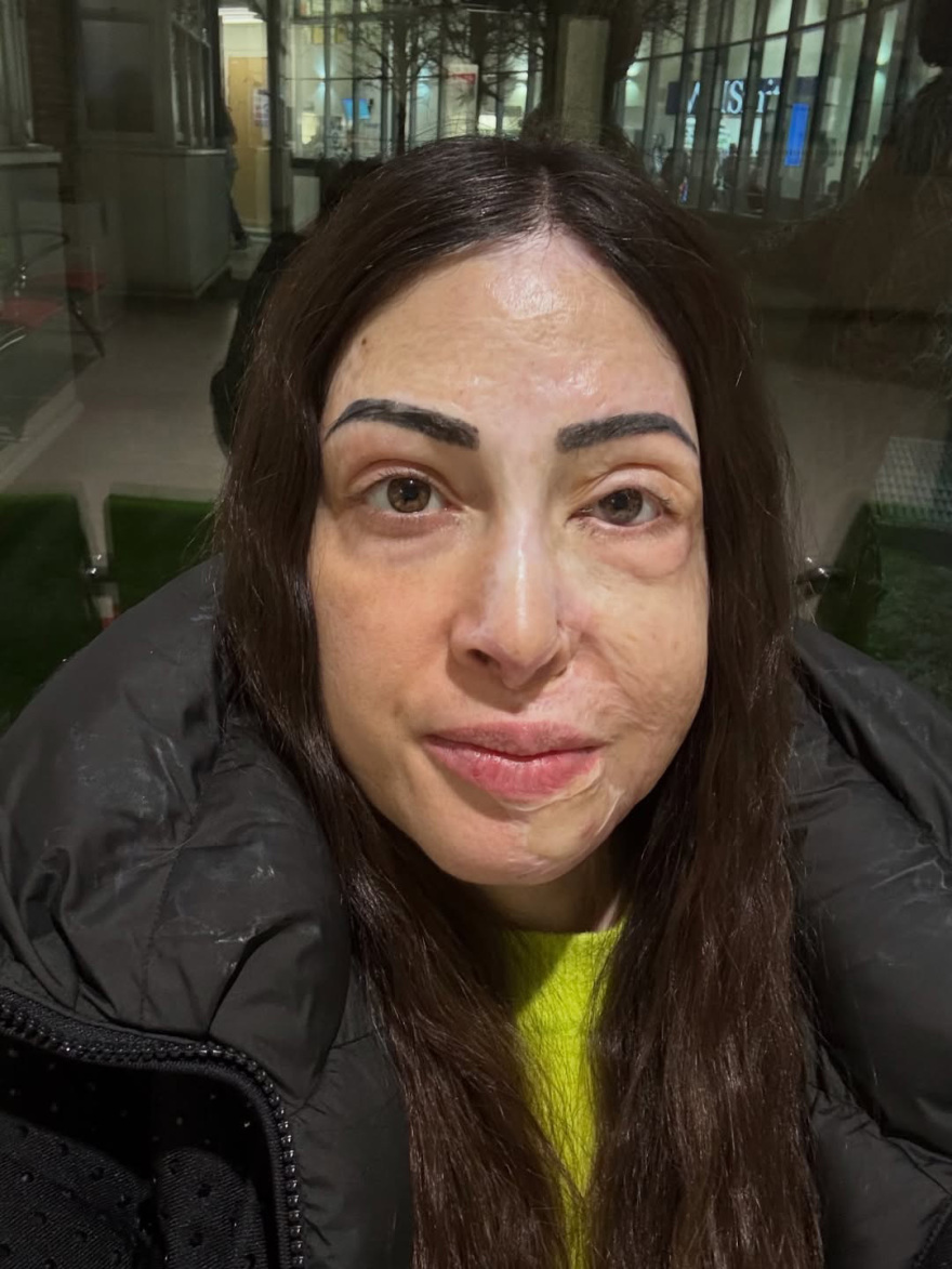 Η Ιωάννα Παλιοσπύρου ανέβασε εικόνες και βίντεο από την αποκατάσταση μετά την επίθεση με βιτριόλι