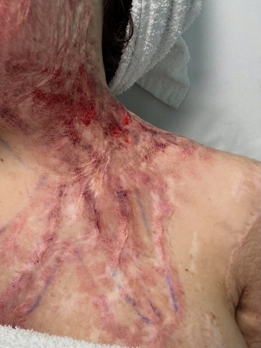 Η Ιωάννα Παλιοσπύρου ανέβασε εικόνες και βίντεο από την αποκατάσταση μετά την επίθεση με βιτριόλι