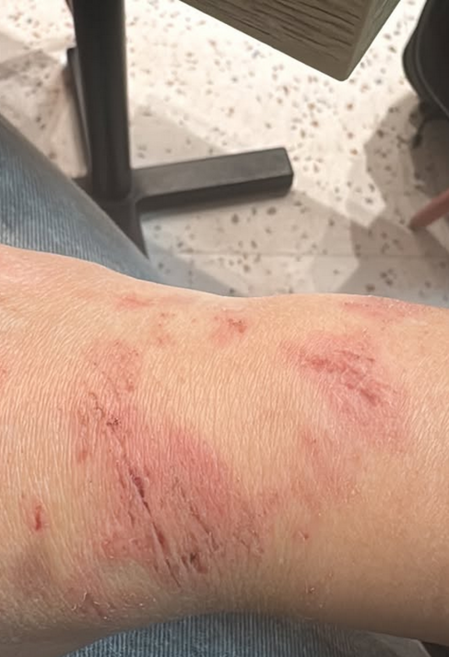 Ιταλίδα πρωταθλήτρια της ποδηλασίας και μοντέλο δείχνει τα τραύματά της μετά από πτώση - «Θα επιστρέψω σύντομα και πιο δυνατή»