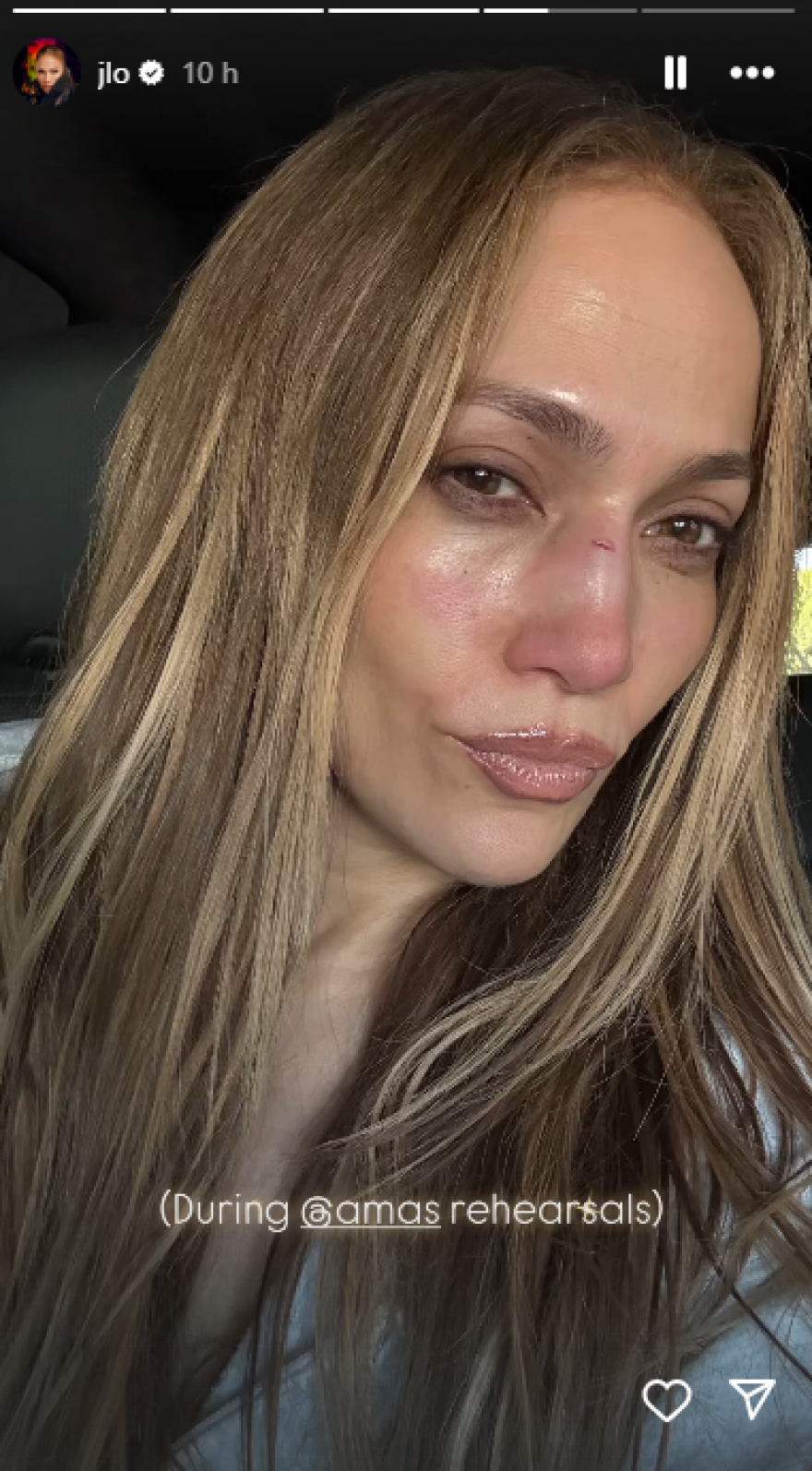 Η Τζένιφερ Λόπεζ τραυματίστηκε στις πρόβες για τα American Music Awards - Δείτε τις φωτογραφίες