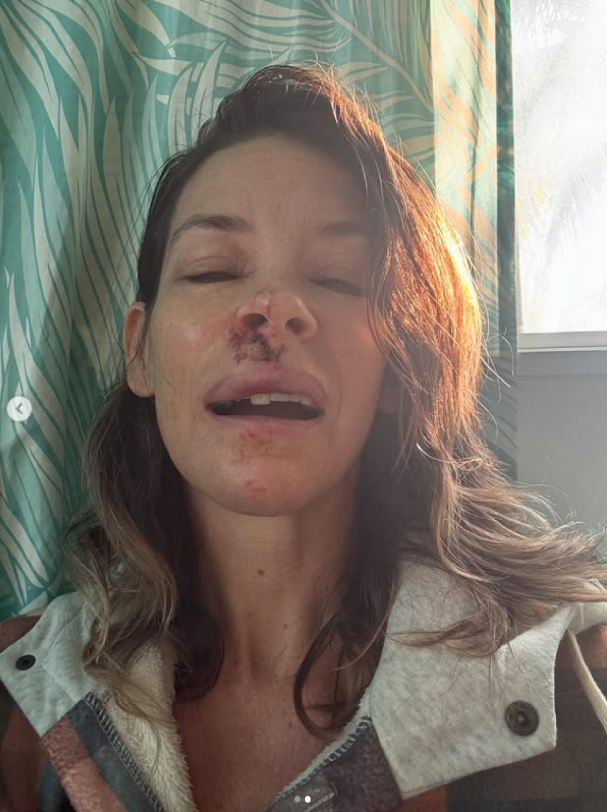 Η Εβάντζελιν Λίλι αποκάλυψε ότι υπέστη εγκεφαλική βλάβη μετά από ατύχημα: Σχεδόν κάθε περιοχή του εγκεφάλου μου υπολειτουργεί