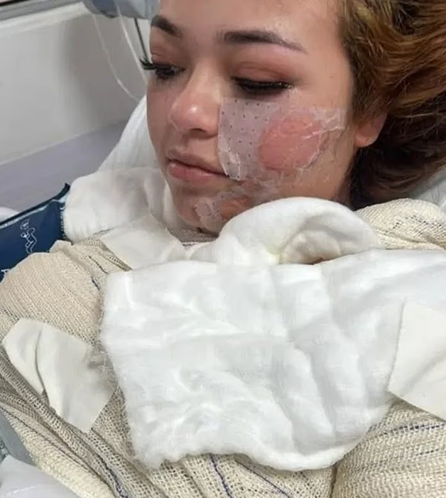 ΦΩΤΟ: Φρικτός θάνατος για 24χρονη στη Βραζιλία: Ζαλίστηκε, έπεσε σε τζακούζι με καυτό νερό και υπέστη εγκαύματα 3ου βαθμού στο κορμί της Φρικτός θάνατος για 24χρονη στη Βραζιλία: Ζαλίστηκε, έπεσε σε τζακούζι με καυτό νερό και υπέστη εγκαύματα 3ου βαθμού στο κορμί της