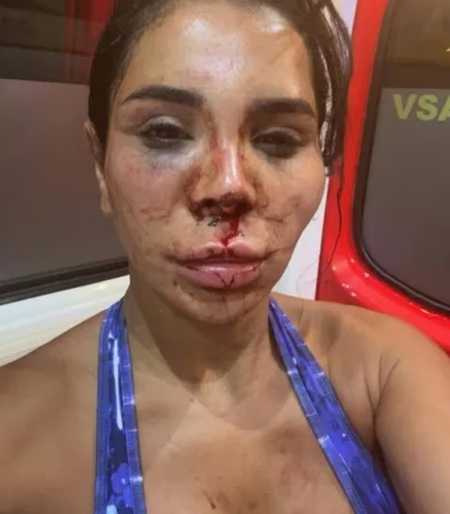 Γαλλία: Τρόμος για 30χρονη Influencer - Διαρρήκτες την χτύπησαν, την έδεσαν και την ψέκασαν με χλωρίνη