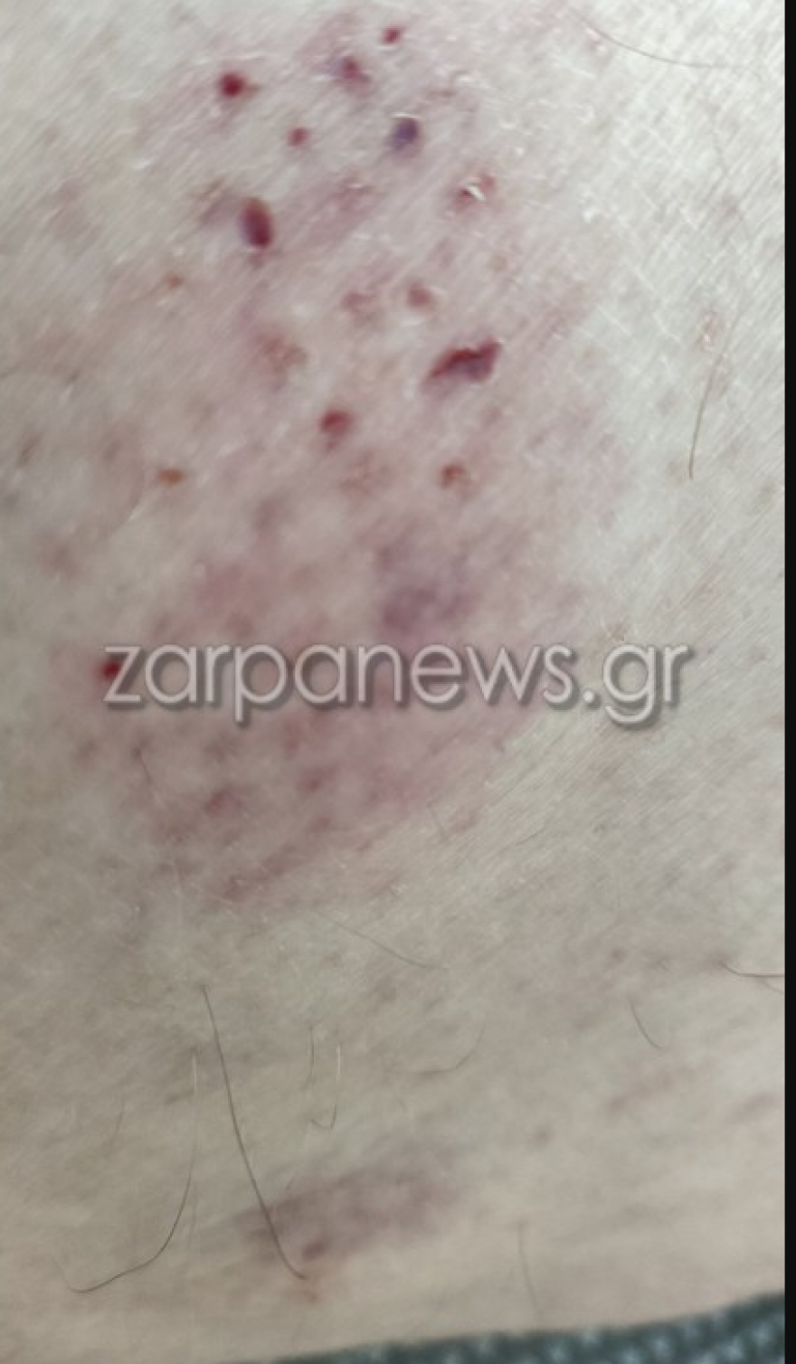 Θαλάσσια χελώνα δάγκωσε λουόμενο στα Χανιά - Πώς να αντιδράσετε αν βρεθείτε κοντά της