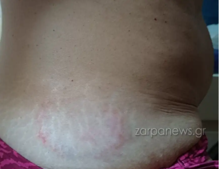 Θαλάσσια χελώνα δάγκωσε γυναίκα στο Μαράθι στα Χανιά - Δείτε φωτογραφίες