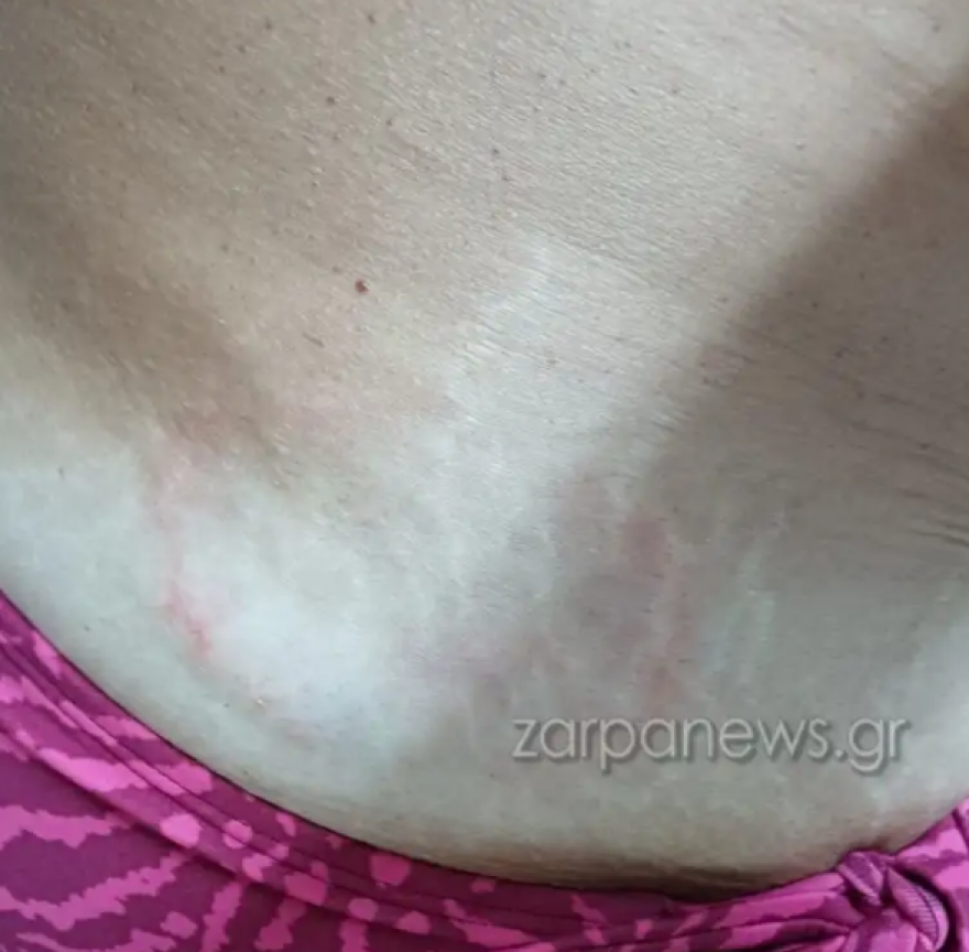 Θαλάσσια χελώνα δάγκωσε γυναίκα στο Μαράθι στα Χανιά - Δείτε φωτογραφίες