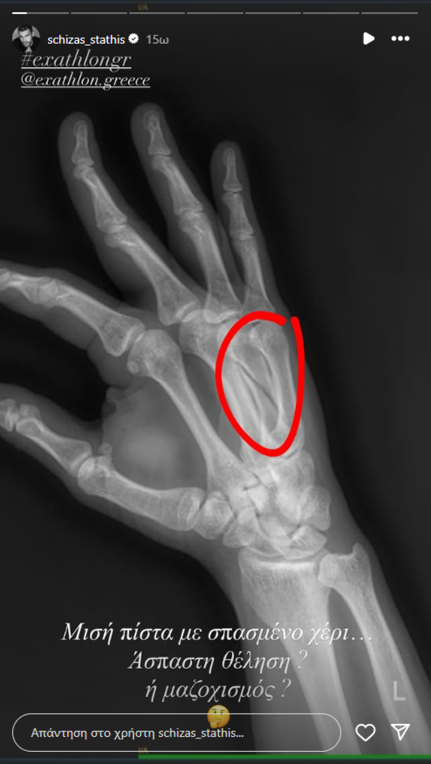 Στάθης Σχίζας: Η πρώτη ανάρτηση μετά την αποχώρησή του από το Exathlon και τον τραυματισμό του