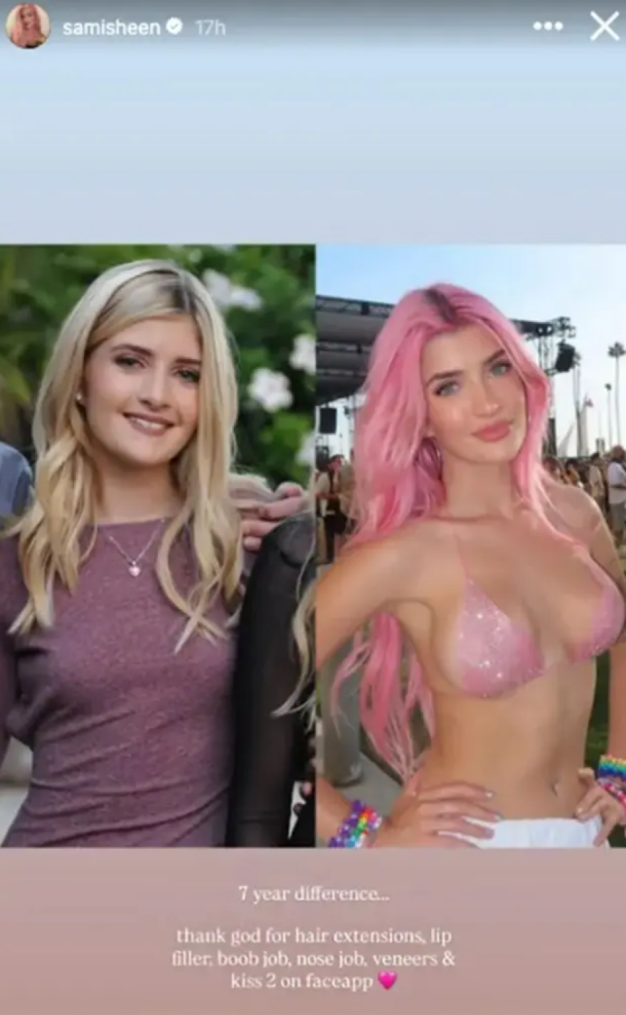 Η 21χρονη κόρη του Τσάρλι Σιν αποκάλυψε όλες τις πλαστικές επεμβάσεις που έχει κάνει: Fillers, ρινοπλαστική και αυξητική στήθους