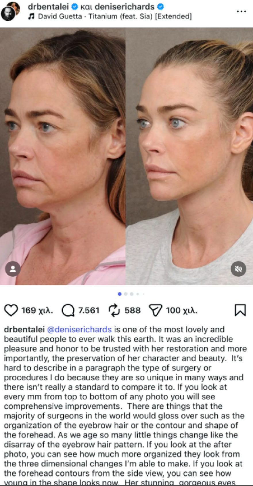 Ντενίζ Ρίτσαρντς: Φωτογραφίες με το πρόσωπό της πριν και μετά το λίφτινγκ